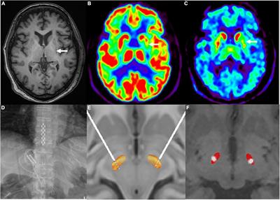 Case report: Combined therapy of bilateral subthalamic nucleus deep brain stimulation and spinal cord stimulation significantly improves motor function in a patient with multiple system atrophy with predominant parkinsonism